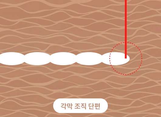타사 기존라식