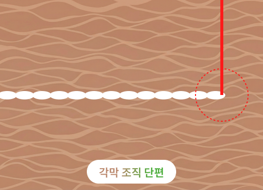 올레이저 라식