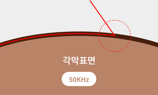 기존라식 50KHz