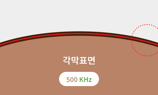 올레이저 라식 500 KHz