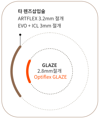 타 렌즈삽입술 대비 GLAZE 2.8mm 최소절개 비교