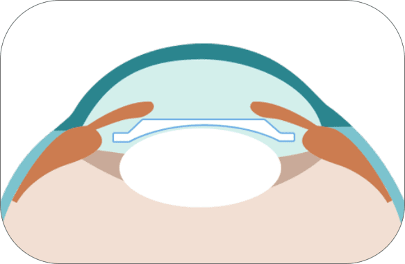 후방렌즈